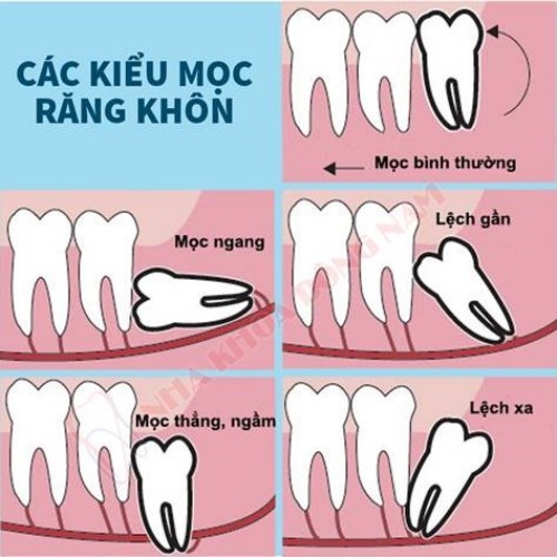 cac kieu moc rang khon